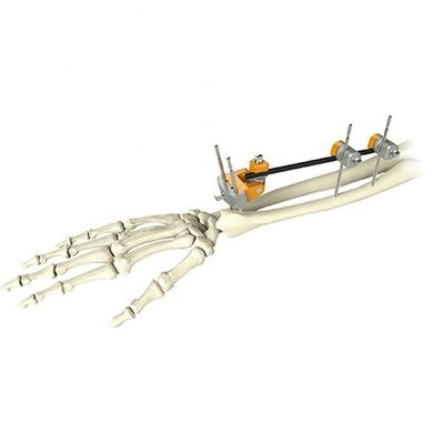 Medische Orthopedische de Breuk Externe Bevestiging van de Ellepijp Distale Straal