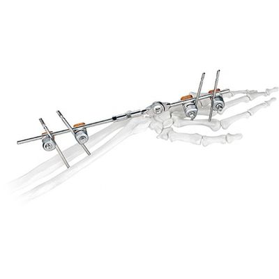 Medische Orthopedische Chirurgische Implant Gezamenlijke Pols Externe Fixator