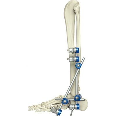 Medisch Orthopedisch Extern de Bevestigingshulpmiddel van de Instrumentenenkel