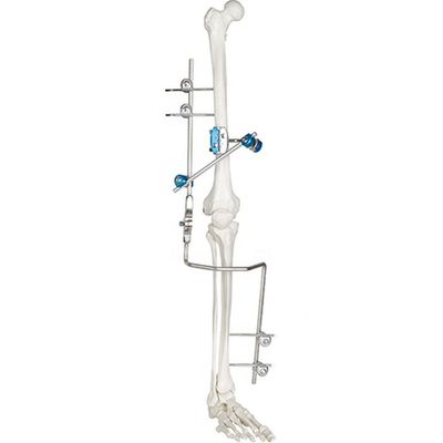 Medische het Apparaten Orthopedische Chirurgische Instrumenten van de Knie Gezamenlijke Externe Bevestiging