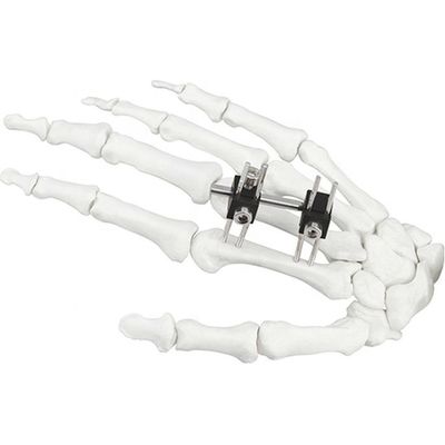 Orthopedisch Chirurgisch Mini Fragment Ilizarov External Fixation-Apparaat