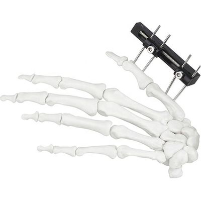 Orthopedisch Chirurgisch Mini Fragment Ilizarov External Fixation-Apparaat