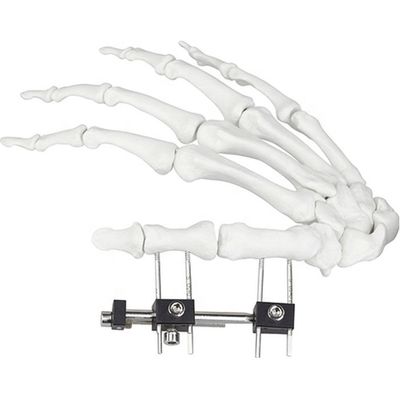 Orthopedisch Chirurgisch Mini Fragment Ilizarov External Fixation-Apparaat