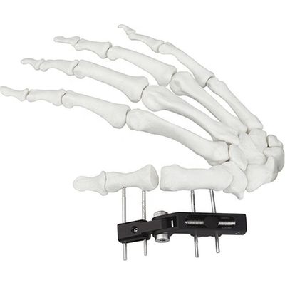 Orthopedisch Chirurgisch Mini Fragment Ilizarov External Fixation-Apparaat