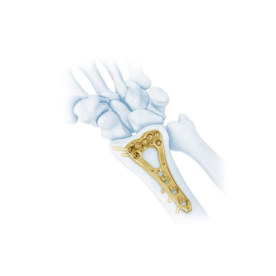 Van de de Straalbreuk van de trauma Multi Aspalm Distale Plaat II